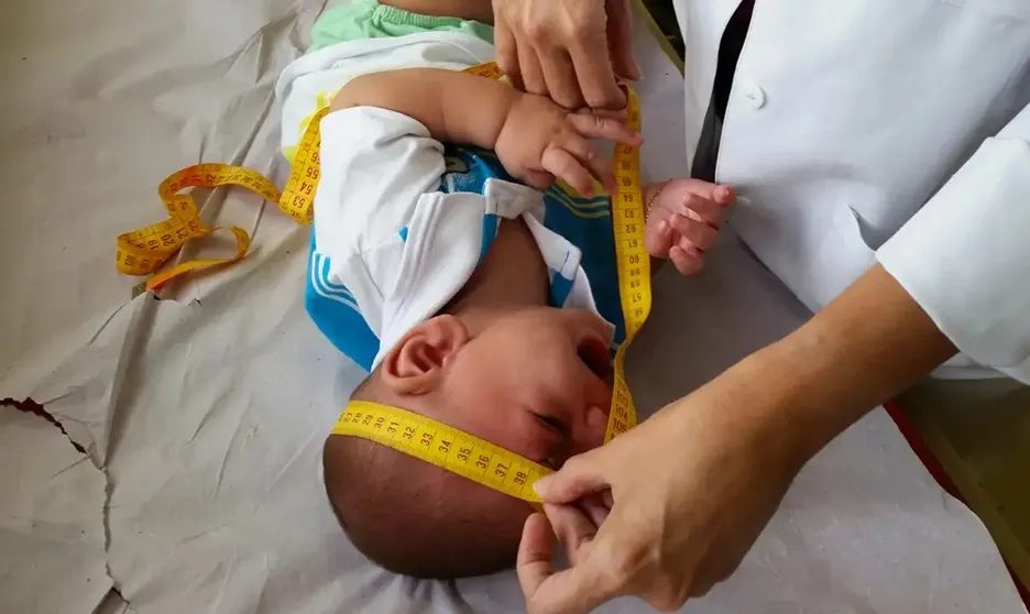 Governo federal garante R$ 60 mil para pessoa com síndrome congênita causada pelo vírus zika durante gestação